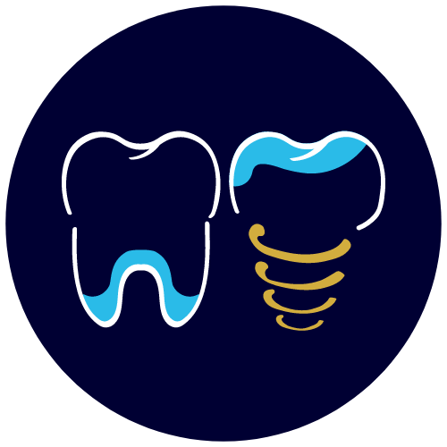 On a recours à l’implant dentaire, avec greffe osseuse ou pas, quand la dent naturelle n’est plus conservable.